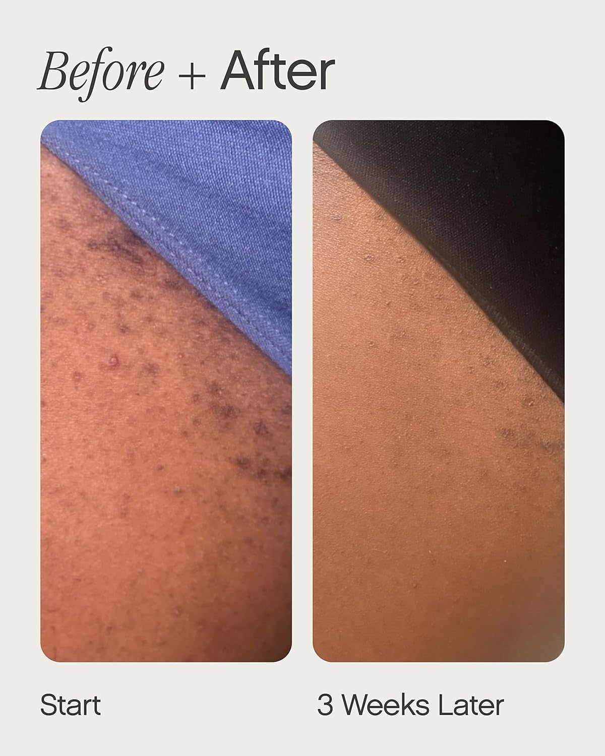 Bare Bliss Ingrown Hair Treatment