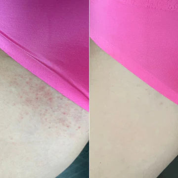 Bare Bliss Ingrown Hair Treatment