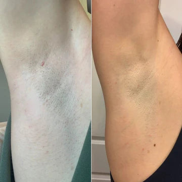 Bare Bliss Ingrown Hair Treatment